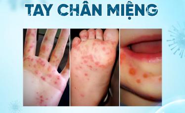 TAY CHÂN MIỆNG "VÀO MÙA" TAY CHÂN MIỆNG "VÀO MÙA"