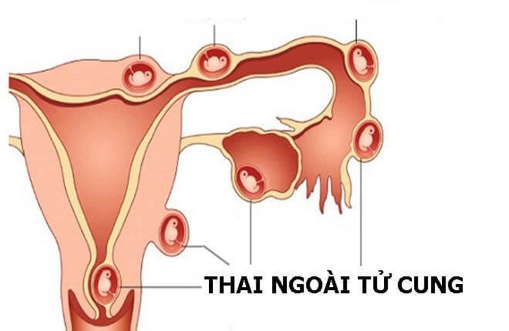 Thai ngoài tử cung,jpg